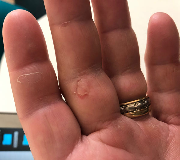 Sailing with no gloves can be dangerous to your hands